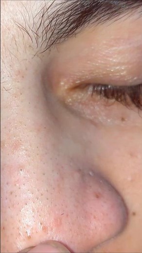 blackheads removal sac dep spa nose strips #asmr #relaxer #asmrsounds #relaxant #relaxingmassage #4