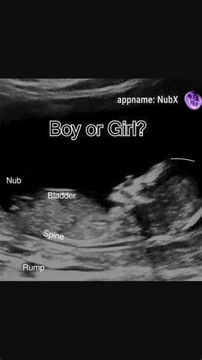 Guess the Gender of Your Baby with Nub Theory