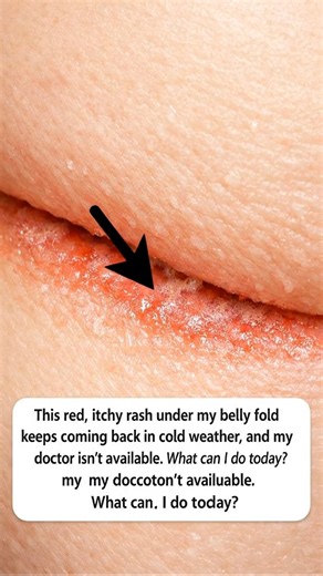 Cold weather hits and the same itchy rash appears under my belly fold… my doctor can’t see me yet, so what can I safely try right now? | Useful Tips