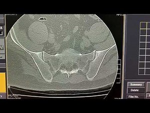CT Scan of the Lumbar Spine: What You Need to Know