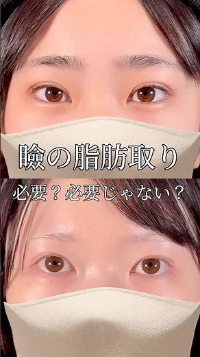 瞼の脂肪取りが向いている人の特徴とは？💭 #shorts