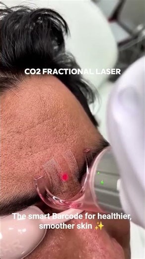 Fractional laser isn’t just a skin treatment ...it’s a beauty barcode for your skin Scan it once