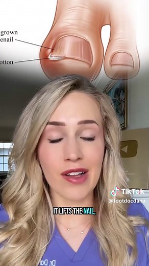 Ingrown Toenail Removal Explained by Doctor