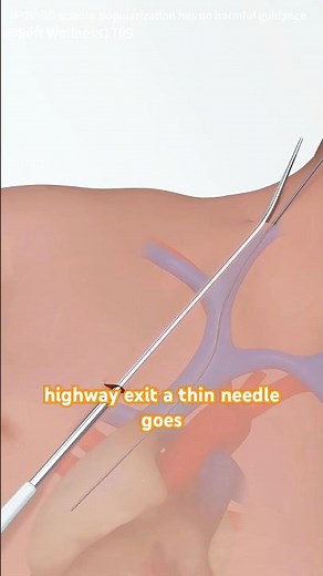 Tunneled Dialysis Catheter Placement (3D Animation) #dialysis #dialysiscatheter #facts #doctor