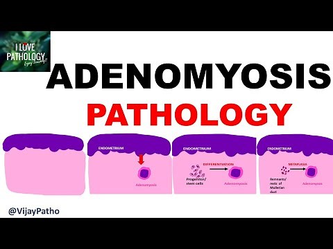 ADENOMYOSIS : Pathology, Clinical Features, Diagnosis & treatment