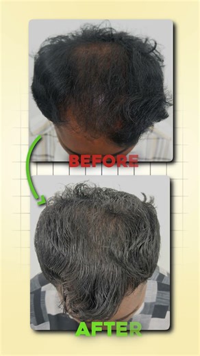 Hair Regrowth Miracle? 😳 GFC Treatment Result