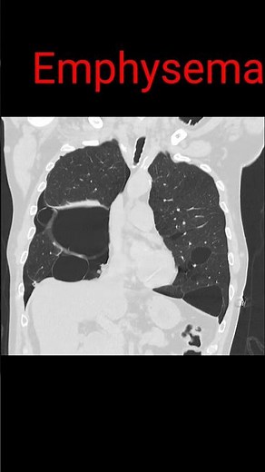 Emphysema || Lung disease #emphysema #shorts #radiology #radiologyjunction