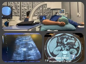ESWL or more popularly known as SHOCKWAVE Lithotripsy is one of the interventions for small kidney, ureteral and urinary bladder stones. Shock wave lithotripsy is a technique for treating stones in the kidney and ureter that does not require surgery. Instead, high energy shock waves are passed and targeted through the body and used to break and fragment stones into pieces as small as grains of sand. Because of their small size, these pieces can pass from the body along with the urine. The proced