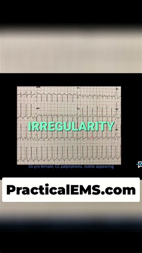 33F Palpitations: Is it SVT? Analyzing ECGs! #shorts