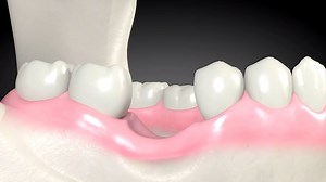 12K views · 147 reactions | معظم حالات ال implant اللى بتجيلك او...