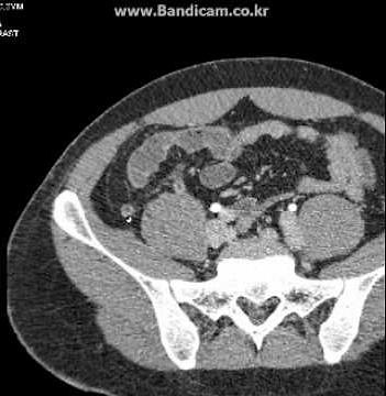 CT interpretation : acute appendicitis