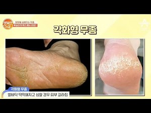 ☆유형별☆ 올바른 무좀 치료 방법! | 행복한 아침 387 회