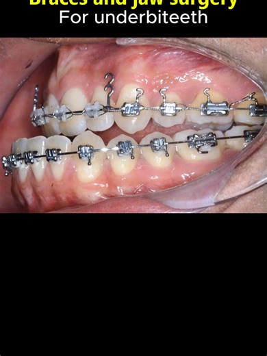 Braces and jaw surgery for underbite teeth #orthodontist #braces #dentist #orthodontics #jawsurgery