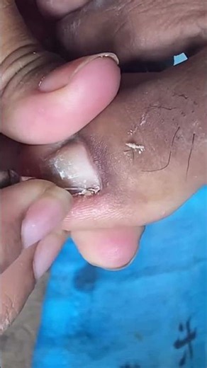 Fungal nail infection treatment #fungal #toenailremoval
