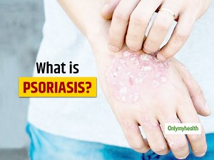Psoriasis: Types, Causes, Symptoms And Treatment By Dermatologist Dr Nandini Barua