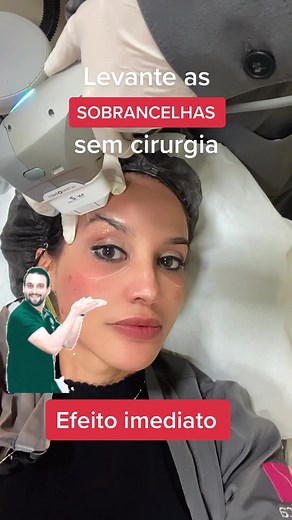 O que achou??? #levantarsobrancelha #flacidezpalpebra #palpebrascaída #eliminaflacidez #ultraformer3 #ultraformer #ultraformerguarulhos