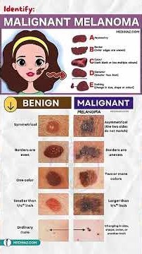 How to Identify Melanoma Skin Cancer – Early Signs & Warning Symptoms