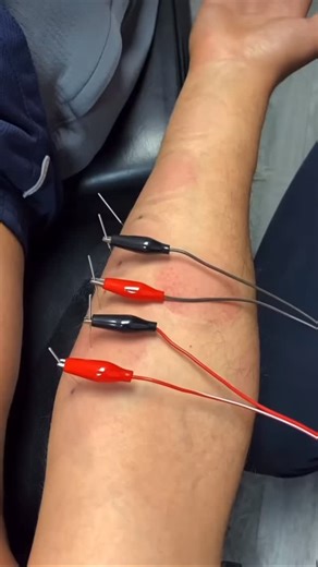 UPPER ARM PAIN Physiotherapy for upper arm pain typically involves a...