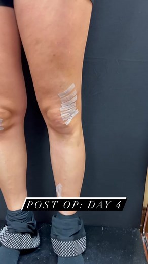 Hi! I’m Irina, the PA at Nelson Vein and Surgical Services. This is post-op day 4 after my phlebectomy procedure! It is common to experience bruising after the phlebectomy. Arnica gel can help reduce the appearance of bruises and alleviate any associated pain or discomfort. Arnica gel is a topical natural remedy made from the arnica plant and is believed to work by reducing inflammation and increasing blood flow to the affected area. Arnica gel is available over the counter at many drugstores or