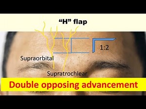 How to design double opposing advancement flaps (H flap)