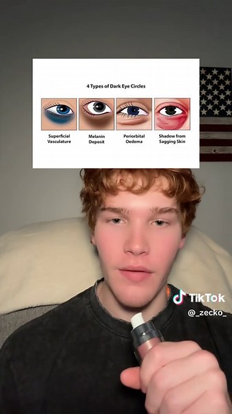 How to get rid of eyebags from hyperpigmentation #eyebags #eyebag #hyperpigmentation #eyes #looks