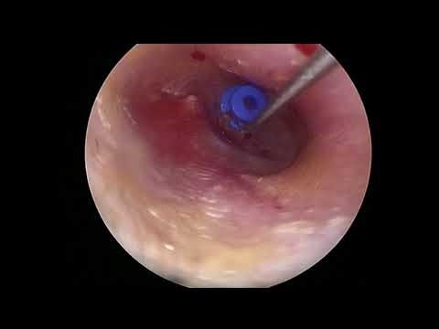 Paparella Type 2 Tympanostomy Tube Insertion R