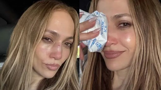 Jennifer Lopez suffers injury during rehearsals, ends up with black eye and a cut