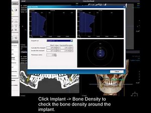 DVR Module: Implant planning