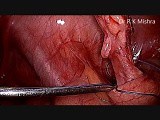 Laparoscopic Appendectomy • Video • MEDtube.net