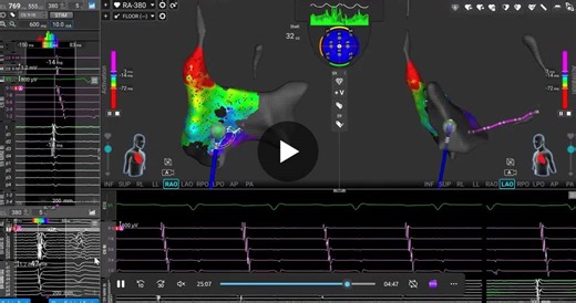 VCU Medical Center EP Case: Successful Ablation with Medtronic's Sphere-9 Mapping Catheter | Peter Demperio posted on the topic | LinkedIn