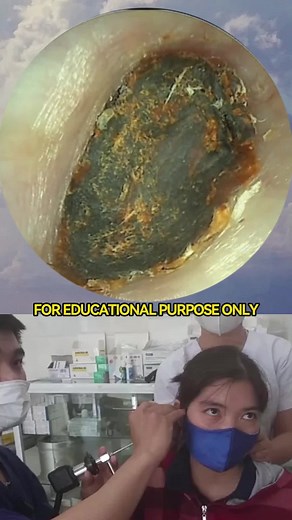 Earwax Removal: Grades of Earache and Canal Expansion