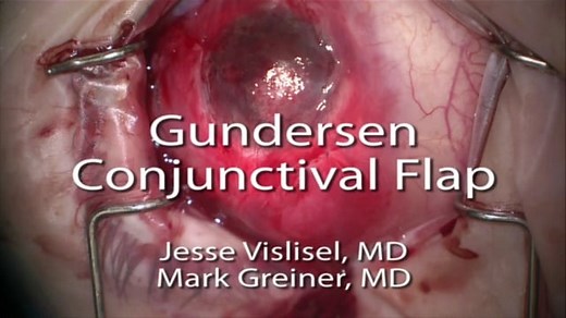 Gundersen Conjunctival Flap