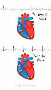 AV Blocks – Progressive Conduction Failure: 1. First-Degree AV Block: Consistent delay at the AV node. Prolonged PR interval (>200 ms). Every impulse eventually reaches the ventricles. 2. Mobitz I (Wenckebach): Progressive PR interval lengthening until a P wave is blocked (a QRS is dropped). Typically at the AV node. Usually benign. 3. Mobitz II: Intermittent, sudden failure of conduction without preceding PR prolongation. Block typically infranodal (Bundle of His or below). Carries significant 