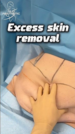 After weight loss.. excess skin removal. ALO Aesthetic