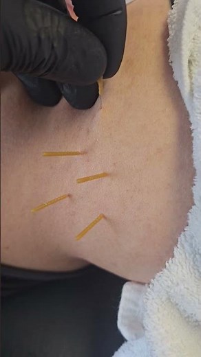 Dry needling for pain relief and trigger points (How deep?)