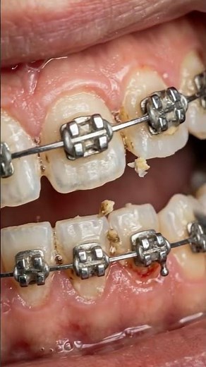Jahre Zahnspangen-Zahnstein Entfernung 😳 Was versteckt sich unter den Brackets?