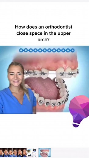 Closing Space in Upper Arch with Braces