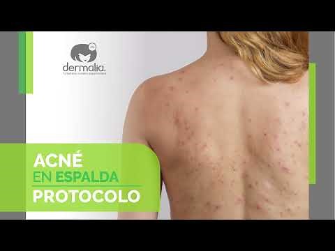EL PEELING ULTRASÓNICO: EL TRATAMIENTO REVOLUCIONARIO PARA EL ACNÉ EN ESPALDA