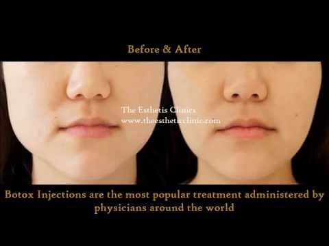Botox Injection Treatment for Masseter Hypertrophy | Jawline Reduction Treatment | Dr. Debraj Shome