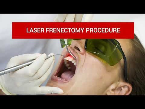 Laser Frenectomy procedure - before and after - Dental Solutions