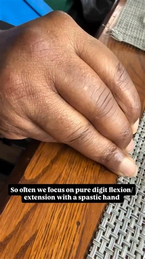 Sheetal Thayil, PT & Lisa Guglielmo, OT on Instagram: "🧠💪 When we think hand recovery post-stroke or brain injury, we tend to laser in on flexion and extension of the digits. But here’s what often gets overlooked 👇 👉 Digit abduction. Encouraging gentle separation of the fingers can actually help reduce overall hand spasticity by promoting more balanced tone and sensory awareness throughout the hand. Whether you’re working in closed-chain positions, administering bracing, or adding simple sen