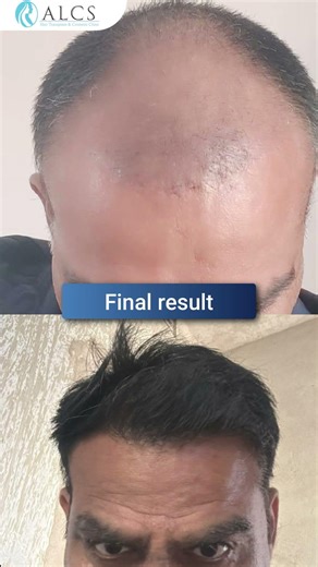 Hair transplant timeline | Month-by-month hair growth transformation