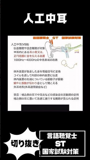 人工聴覚器 人工中耳 人工内耳 骨固定型補聴器 聴性脳幹インプラント 残存聴力活用型インプラント