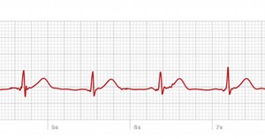 A look at the Apple Watch’s ECG, from someone who needs it