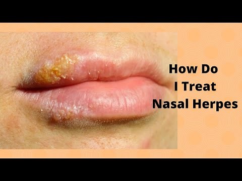 How Do I Treat Nasal Herpes