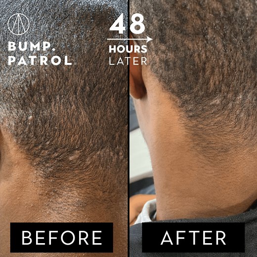 Patrol Grooming Bump Patrol Original Strength Aftershave Cleanser 114ml Paraben-Free Formula for Razor Bumps & Ingrown Hairs