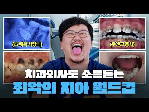 치과의사가 본 최악의 치아 월드컵ㄷㄷ (약혐주의)