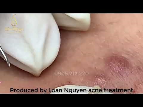 massive blackheads on nose and lips - Clean Giant Blackheads on Nose 2023 - spa - hana spa
