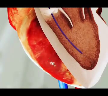 During a left heart catheterization the physician will typically use a pigtail catheter to cross the aortic valve to enter the left ventricle. Many things can be assessed including left ventricular function, left ventricular wall stress (EDP), mitral valve regurgitation, and aortic valve stenosis as the catheter is pulled back across the aortic valve into the aorta. In this clip you will see contrast being given through the pigtail catheter revealing the left ventricle as it contracts! 👀 Follow