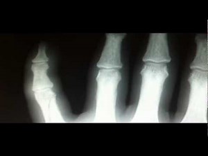 Finger Fracture: X-ray Findings, Treatment